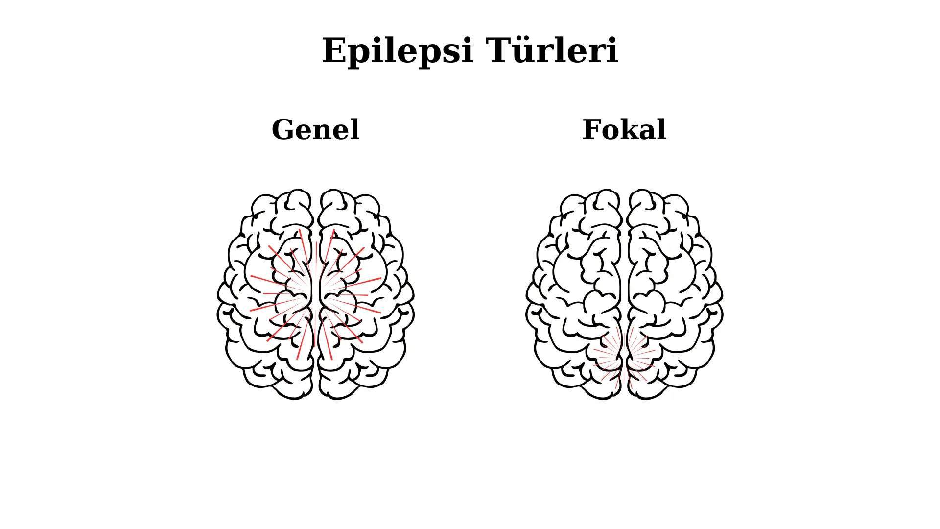 Epilepsi Türleri