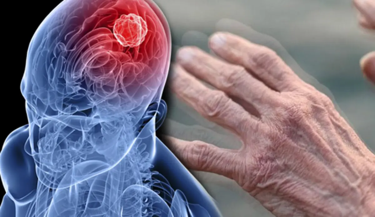Parkinson Tedavisinde İlaç Dışı Yöntemler